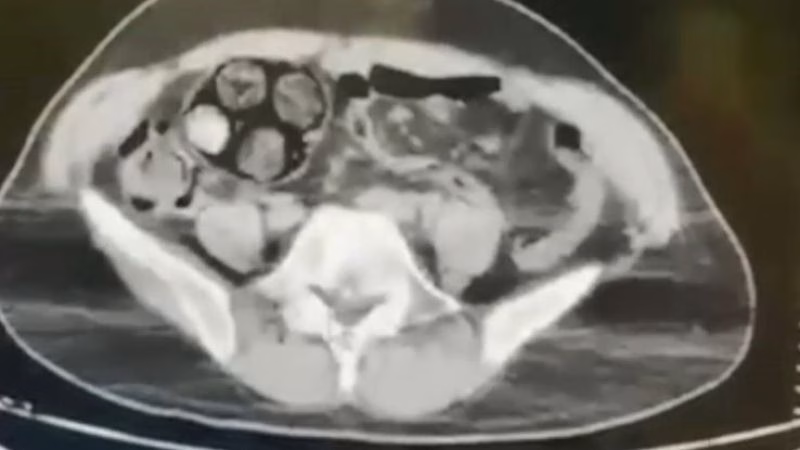 Ölümle Dans! İranlı Kuryenin Midesinden Çıkanlar Şok Etti!